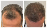 Your hair transplant and cost Abrams Aesthetics & Hair Restoration in Henderson in Nevada