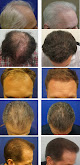 Your hair transplant and cost Advanced Medical Hair Institute / Joseph L. Williams, Md in Las Vegas in Clark