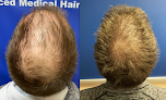 Your hair transplant and cost Advanced Medical Hair Institute in Reno in Nevada