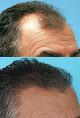 Your hair transplant and cost Aesthetic Scalp Chicago in Chicago in IL