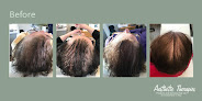 Your hair transplant and cost Aesthetic Therapies in Woodbury in Minnesota