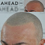 Your hair transplant and cost Ahead Ink Smp in North Bergen in New Jersey