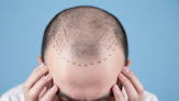 Your hair transplant and cost Ai Hair Transplant Miami in Coral Gables in Florida