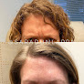 Hair transplant clinic Ak Beautiful You Medical Spa in Anchorage