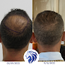 Your hair transplant and cost American Mane in Aventura in Florida