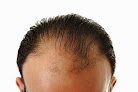 Your hair transplant and cost Anagen Hair Restoration in Silver Spring in Maryland