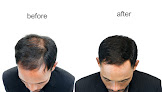 Your hair transplant and cost Anagen Hair Restoration in Washington in District of Columbia