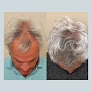 Your hair transplant and cost Anderson Center For Hair in Atlanta in Georgia