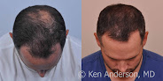 Your hair transplant and cost Anderson Center For Hair in Alpharetta in Georgia
