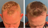 Your hair transplant and cost Ann Arbor Plastic Surgery in Ann Arbor in Michigan