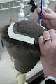 Your hair transplant and cost Apollo Of Louisville in Jeffersontown in KY