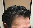 Your hair transplant and cost Arizona Hair Replacement in Glendale in Maricopa
