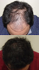 Your hair transplant and cost Armani Medical in Dallas in Texas