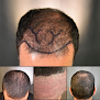 Your hair transplant and cost Arocha Hair Restoration in Austin in Texas