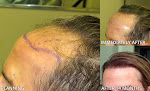 Your hair transplant and cost Artas - Robotic Hair Transplant Center in Skokie in IL