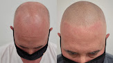 Your hair transplant and cost Artisan Scalp Micropigmentation in Middlesex in New Jersey