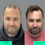 Your hair transplant and cost Athens Hair Transplants in Omaha in NE