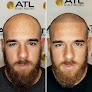 Your hair transplant and cost Atl Scalp Micro in Atlanta in Georgia