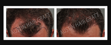 Your hair transplant and cost Austin Hair Graft in Austin in Texas