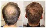 Your hair transplant and cost Austin Hair Restoration Clinic in Austin in Texas