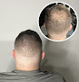 Your hair transplant and cost Authentic Scalp Micropigmentation in Plainfield in Illinois