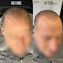 Your hair transplant and cost Axiome Scalp Ink in Pittsburgh in Pennsylvania