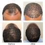 Your hair transplant and cost Az Hair Restoration Clinic – Hair Transplant Raleigh Nc in Raleigh in North Carolina