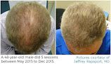 Your hair transplant and cost Az Prp Hair Therapy in Gilbert in Maricopa