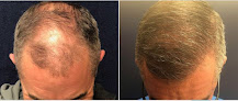 Your hair transplant and cost Balance Hair Restoration in Ann Arbor in Michigan