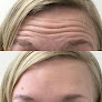 Your hair transplant and cost Bare Medical Spa + Laser Center in Burlington in Vermont