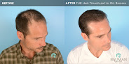Your hair transplant and cost Bauman Medical in Boca Raton in Florida