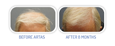 Your hair transplant and cost Bend Vitality Clinic in Bend in Oregon