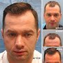 Your hair transplant and cost Bernstein Medical – Center For Hair Restoration in New York in New York