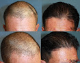Your hair transplant and cost Beverly Hills Hair Restoration in Beverly Hills in California