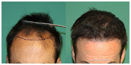 Your hair transplant and cost Bks Hair Restoration in Haddonfield in New Jersey