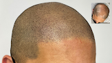 Your hair transplant and cost Black & White Smp By Dy in Bethesda in Maryland