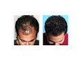 Your hair transplant and cost Bosley - Hair Restoration & Transplant - Atlanta in Atlanta in Georgia