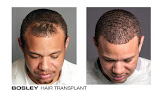 Your hair transplant and cost Bosley - Hair Restoration & Transplant - Baltimore in Towson in Maryland