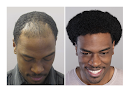 Your hair transplant and cost Bosley - Hair Restoration & Transplant - Columbia (Maryland) in Columbia in Maryland
