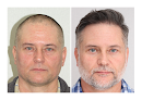 Your hair transplant and cost Bosley - Hair Restoration & Transplant - Knoxville in Knoxville in Tennessee