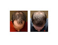 Your hair transplant and cost Bosley - Hair Restoration & Transplant - San Francisco in San Francisco in California