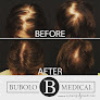 Your hair transplant and cost Bubolo Hair Restoration in Acworth in Georgia