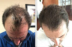 Your hair transplant and cost Bubolo Medical in Marietta in Georgia