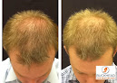 Your hair transplant and cost Buckhead Hair Restoration in Atlanta in Georgia