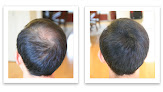 Your hair transplant and cost Caboki Llc in Cranbury in New Jersey