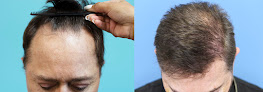Your hair transplant and cost California Hair Surgeon in Walnut Creek in California