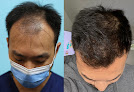 Your hair transplant and cost California Hair Surgeon in San Jose in California