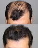 Your hair transplant and cost Capitis Medical And Aesthetics in Roseville in California
