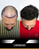Your hair transplant and cost Care4Hair in Miami in Florida