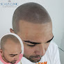 Your hair transplant and cost Carlos Montes Scalp Micropigmentation Specialist At Novaderm Hair Institute in Bayamón in Puerto Rico